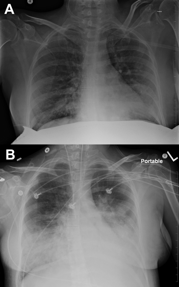 Course of influenza B virus infection and necrotizing pneumonia in peripartum woman, 2012, New York, USA. A) Chest radiograph at time of admission. B) Chest radiograph 1 day later, demonstrating progression of pneumonia.