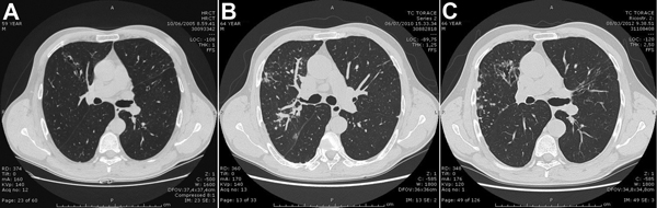 High-resolution computed tomographic chest images of a man with prolonged pulmonary disease caused by Mycobacterium marseillense, Italy. A) October 6, 2005. Bilateral bronchiectasis, mainly in the middle lobe and lingula, associated with multiple nodules and middle lobe consolidation. B) June 7, 2010. Increased micronodular opacities, mainly in the right middle and lower lobes, and a worsening of the bronchiectasis. C) August 3, 2013. Persistence of nodular component, cavitation, and wider bronc