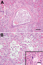 Thumbnail of A) Bronchiolar epithelium of chimpanzees infected with human metapneumovirus, United States, 2009, showing cell variation from attenuated to piled and disorganized. Epithelial cells lack cilia, and lumens contain foamy macrophages, neutrophils, and hemorrhage. Adjacent air spaces are filled with similar inflammatory cells. Scale bar = 70 μm. B) Alveoli lined with plump type II pneumocytes and fibrin. Inset: Rare, deeply basophilic, smudged nuclei are present in some areas. Scale bar