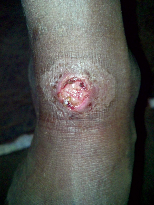 Example of lesion from which sample was obtained and Haemophilus ducreyi DNA was amplified, Solomon Islands, 2013. Photograph ©2014 Michael Marks.