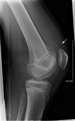 Thumbnail of Lateral radiograph of right knee demonstrating suprapatellar effusion without acute osseous injury (arrow).
