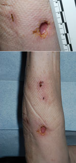 Thumbnail of Forearm lesion after incision and drainage in immunosuppressed woman with cutaneous Legionella longbeachae infection, United Kingdom.