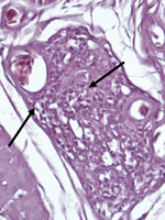 Thumbnail of Section of the crop of a white-eyed conure (Aratinga leucophthalmus; bird no. 70 [Table 1]) from Brazil that was infected with avian bornavirus genotype 4. Stain shows mononuclear infiltration typical of proventricular dilatation disease (arrows). Hematoxylin and eosin stain; original magnification ×1,000.