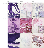 Thumbnail of Periodic acid-Schiff (PAS) staining and immunohistochemical analysis of samples from Echinococcus vogeli lesions, with monoclonal antibodies against Em2 and EM10 of E.  vogeli (A, B, C), E. multilocularis (D, E, F), and E. granulosus (G, H, I) lesions. Staining was performed on archived tissue from human patients with alveolar and cystic echinococcosis for comparison, and from the patient with E. vogeli infection who immigrated to the Netherlands from Suriname (E. vogeli infection i