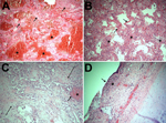 Thumbnail of Results of autopsies for patients who died from influenza A(H1N1) virus infection during the 2013–14 influenza season in Florida Department of Health Region 3, Florida, USA. A) Marked intraalveolar hemorrhage (stars) and hyaline membranes (arrows) were seen during the early phase of diffuse alveolar damage and were the most common findings in the 5 autopsy cases reviewed. B) Hyaline membranes, a proteinaceous exudate replacing the alveolar walls (arrows), are prominent in this lung 