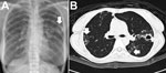 Thumbnail of Chest radiograph (A) and computed tomography scan (B) images for a patient with pulmonary disease due to Mycobacterium abscessus subsp. abscessus. A) The arrow indicates a cavity with surrounding consolidation over the left upper lung. B) Vertical arrow indicates bronchiectasis; horizontal arrow indicates nodules.