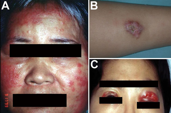 Skin lesions caused by Mycobacterium abscessus subsp. abscessus. A) Diffuse erythematous papular eruptions on the face and bilateral cervical lymphadenitis in a middle-aged man. B) A circumscribed subcutaneous nodule with pus discharge on the right arm of a 12-year-old boy. C) Wound infection over both upper eyelids of a 36-year-old woman; the infection developed 1 week after cosmetic surgery.