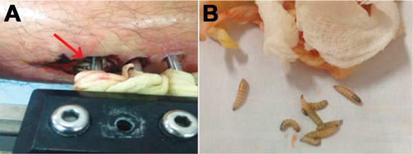 Pin-site myiasis in a 26-year-old male soldier, Colombia. A) Larvae of Cochliomyia hominivorax screwworm fly around an external metallic fixator (arrow). B) Larvae isolated from the insertion wound of the external metallic fixator