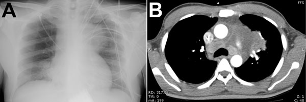 Clinical studies of a patient with melioidosis, Royal Darwin Hospital, Darwin, Northern Territory, Australia. A) Chest radiograph shows a soft-tissue mass associated with the left side of the mediastinum and obscuring the aortic arch. B) Chest computed tomography scan shows a large loculated mass in the anterior mediastinum; the mass is contiguous with multiple enlarged mediastinal lymph nodes and with pulmonary consolidation.