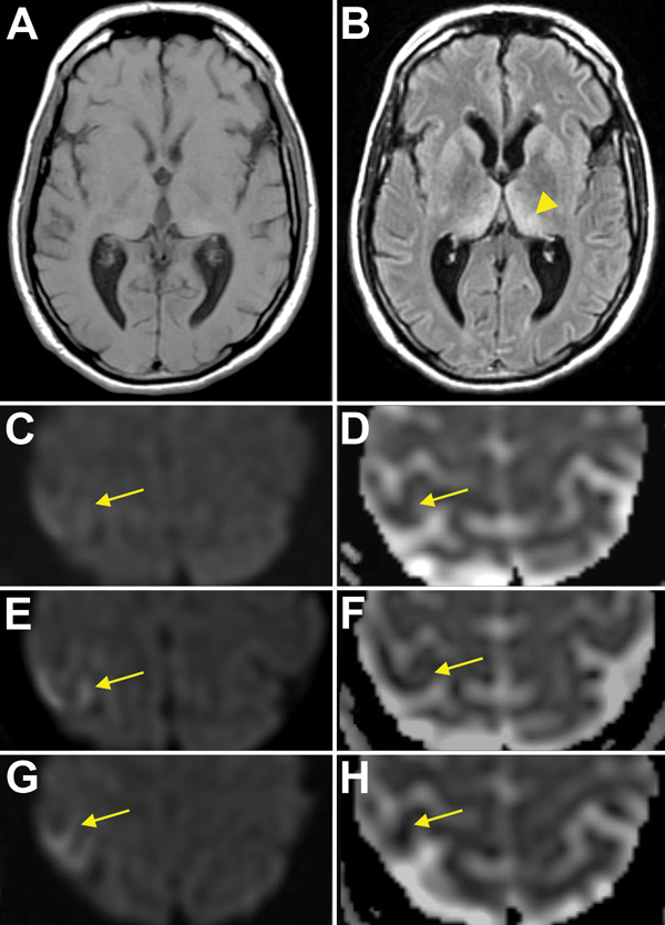 Magnetic resonance imaging (MRI) results for a US patient with variant Creutzfeldt-Jakob disease. A) T1 sequence. B) T2 FLAIR sequence showing the “pulvinar” or “hockey stick” sign (arrowhead). Initial Diffusion Weighted Imaging (DWI) (C) and Apparent Diffusion Coefficient (ADC) (D) images show subtle restricted diffusion in right primary motor cortex; subsequent MRIs show increasing hyperintensity on DWI (E,G) and further attenuation on ADC (F,H), consistent with the “cortical ribbon” sign. Ori
