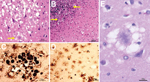 Thumbnail of Results of histopathologic and immunohistochemical analyses for a US patient with variant Creutzfeldt-Jakob disease. A) Hematoxylin and eosin staining shows many typical florid plaques (A, arrow) occasionally forming clusters; large vacuole spongiform change is also present (A; original magnification ×10). B) Plaques often not of the florid type along with spongiform change are present in cerebellum (arrows; original magnification ×20). C, D) Prion protein immunostaining confirms th