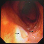 Thumbnail of Multiple, shallow, oozing ulcers at the terminal ileum (arrows) detected by colonoscopy on day 4 of hospitalization for case-patient 1, who had a disseminated infection with Talaromyces marneffei.