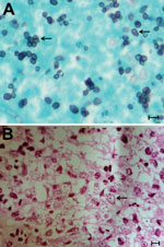 Thumbnail of Nasopharyngeal biopsy specimen from case-patient 1, who had a disseminated infection with Talaromyces marneffei. A) Grocott silver staining showing abundant yeast cells (arrows) with central septa 4–5 µm in diameter. B) Hematoxylin and eosin staining showing necrotic material admixed with blood and fibrin with aggregates of foamy macrophages (arrow). Scale bars indicate 5 μm.