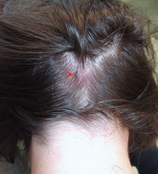 Dermacentor-borne necrosis erythema lymphadenopathy/tickborne lymphadenopathy/scalp eschar associated with neck lymphadenopathy after a tick bite. Shown is an erythematous, punctiform lesion in the scalp (arrow head), accompanied by enlarged occipital lymph nodes