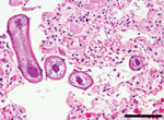Thumbnail of Multiple cross-section of Ascaris suum nematode larvae in the lung of cattle. Larvae have prominent lateral alae and lateral cords. Several scattered eosinophils and macrophages and abundant fibrin are also shown. Scale bar indicates 200 µm.