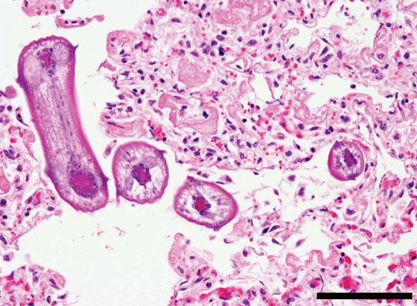 Multiple cross-section of Ascaris suum nematode larvae in the lung of cattle. Larvae have prominent lateral alae and lateral cords. Several scattered eosinophils and macrophages and abundant fibrin are also shown. Scale bar indicates 200 µm.