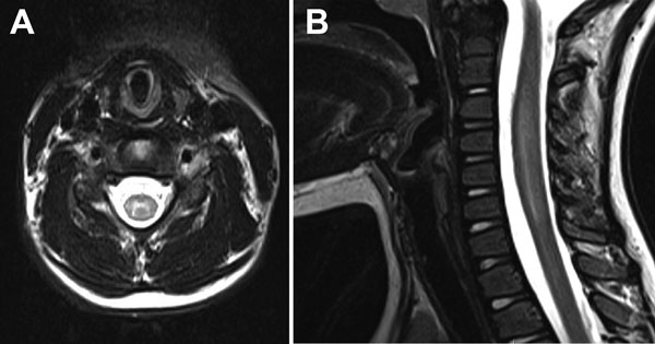 Magnetic resonance imaging of 6-year-old girl with flaccid paralysis and enterovirus C105 infection, Virginia, USA, October 2014. A) Axial T2-weighted image of the cervical spine demonstrating abnormal hyperintensity of the central gray matter (right to left). B) Sagittal T2-weighted image of the cervical spinal cord demonstrating faint longitudinally extensive central hyperintensity and associated cord edema.