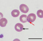 Thumbnail of Wright-stained peripheral blood smear from patient A (index case-patient), a renal transplant recipient infected with Babesia microti parasites, Wisconsin, USA, 2008. The smear shows intraerythrocytic Babesia parasites, a ring form (black arrow), and a Maltese cross or tetrad form (red arrow), which is pathognomonic for babesiosis. Scale bar indicates 10 μm.