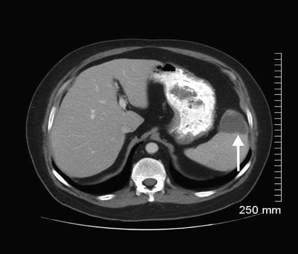 Computed tomography (CT) scan of the abdomen of patient B, a renal transplant recipient infected with Babesia microti parasites, Wisconsin, USA, 2008. Taken on November 5, the scan shows a splenic infarction (white arrow) that had not been visualized on a CT scan on October 5. Although the cause of the splenic infarction was not determined, the infarction might have been a complication of babesiosis, as reported for other patients (16,17).