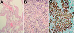 Thumbnail of Histologic manifestations of Blastomyces gilchristii infection in a 27-year-old woman, Ontario, Canada. A) Nonconsolidated lung. Thick hyaline membranes, characteristic of diffuse alveolar damage and acute respiratory distress syndrome, line the alveoli. Hematoxylin and eosin (H&amp;E) stain, original magnification x400. B) Consolidated lung. Alveoli are completely filled with B. gilchristii yeast cells and neutrophils. B. gilchristii cells are pale bluish-gray with a distinct cell 