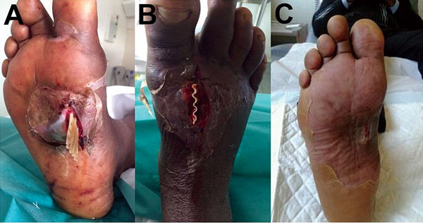 A) Foot of a 47-year-old man showing wound infected with Sporolactobacillus laevolaticus, Marseille, France. B) Drainage of a cellulitis abscess. C) Extent to which the wound on the arch of the foot had healed 6 weeks after surgery and antimicrobial drug therapy. A color version of this figure is available online (http://wwwnc.cdc.gov/EID/article/21/11/15-1197-F1.htm). 