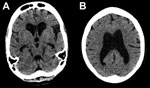 Thumbnail of Representative axial cuts from noncontrast head computed tomography scan imaging of a 30-year-old woman with encephalitis resulting from Ebola virus infection, Sierra Leone. Images show global atrophy in keeping with nonobstructive ventriculomegaly and no periventricular low attenuation: A) subcortical atrophy; B) cortical atrophy. There was no evidence of hydrocephalus, previous stroke, or intracranial hemorrhage. A cavum septum pellucidum was noted in other images. 
