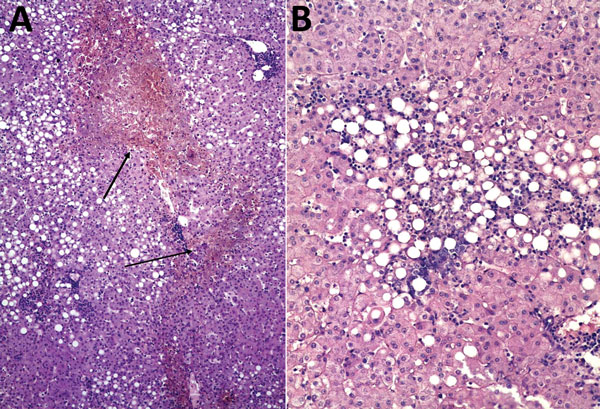 Histopathologic appearance of liver biopsy sample from woman with fatal human monocytic ehrlichiosis, Mexico, 2013. A) Necrotic hepatic lesions in a patchy distribution (arrows). Hematoxylin and eosin (H&amp;E) stain; original magnification ×100. B) Macrovesicular steatosis and inflammatory lymphocytic infiltrate. H&amp;E stain; original magnification ×200. 