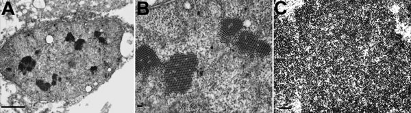 Electron micrographs of polyomavirus-like particles in lung from a child with fatal acute respiratory illness. A) Low-power view of a nucleus displaying multiple electron dense crystalline arrays. Scale bar indicates 0.5 μm; original magnification ×10,000. B) Higher-power magnification of nucleus in panel A. Scale bar indicates 100 nm; original magnification ×30,000. C) Large cluster of putative polyomavirus virions. Scale bar indicates 250 nm; original magnification ×20,000.