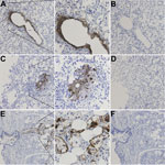 Thumbnail of Immunohistochemical detection of WU polyomavirus viral protein 1 in respiratory tract of a child with fatal acute respiratory illness. Human lung tissue at original magnification of ×200, stained with a monoclonal antibody against WU polyomavirus viral protein 1 (designated NN-Ab06) (A, C) or an isotype control antibody (B, D). Human tracheal tissue at original magnification of ×200, stained with NN-Ab06 (E) or an isotype control antibody (F). The middle panels show insets from pane