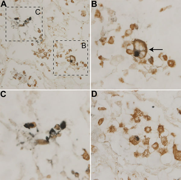 Detection of WU polyomavirus viral protein 1 in CD68-positive cells from a child with fatal acute respiratory illness. Lung tissue stained with NN-Ab06 (blue) and a monoclonal antibody against CD68 (brown). A) Tissue at original magnification of ×400. B) Closer view of cell from panel A consistent with a foamy macrophage (arrow). Original magnification ×1,000. C) Closer view of cells from panel A. Original magnification ×1,000. D) Different field of the tissue section with another double-positiv