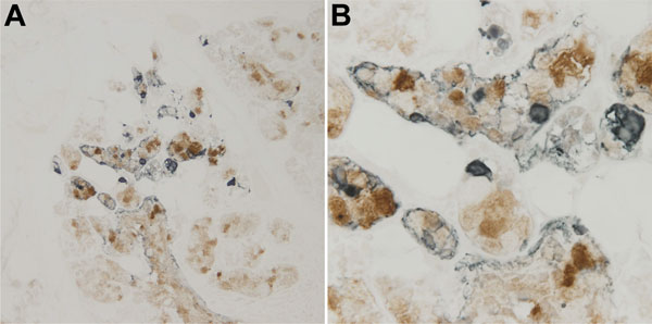 Detection of WU polyomavirus viral protein 1 in close proximity to MUC5AC-positive cells in the trachea of a child with fatal acute respiratory illness. Tracheal tissue stained with NN-Ab06 (blue) and a monoclonal antibody against MUC5AC (brown). A) Tissue at original magnification of ×200. B) Tissue at original magnification of ×600.