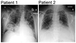 Thumbnail of Admission chest radiographs of 2 adults with severe infections with adenovirus type 7 in family, Illinois, USA, 2014. Chest radiograph of patient 1 shows diffuse parenchymal consolidation involving all lobes. Chest radiograph of patient 2 shows interstitial changes in all lung fields and cardiomegaly.