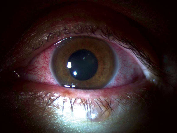 Slit lamp examination of the left eye of a physician from the United States who contracted Ebola virus disease in Liberia and had eye inflammation develop during convalescence. Image shows diffuse blood vessel injection, mild corneal edema with fine inferior keratic precipitates, fibrin reaction, and leukocytes in the anterior chamber without hypopyon. Used with permission of the patient.