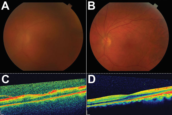 Color fundus and optical coherence tomography (OCT) images during active uveitis and after resolution for a physician from the United States who contracted Ebola virus disease in Liberia and had eye inflammation develop during convalescence. A) Color fundus image of the left eye showing a hazy view to the posterior pole during active uveitis (standardization of uveitis nomenclature classification grade 2–3). B) Color fundus image of the left eye showing a clear view to the posterior pole after r