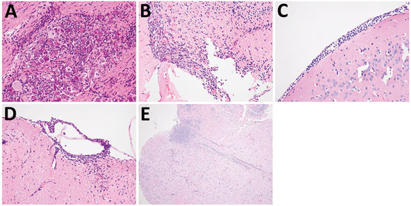 Central nervous system pathology in mice that had signs of neurologic involvement and succumbed to infection with bimBm and bimBp Burkholderia pseudomallei isolates. Evidence of central nervous system pathology was demonstrated in these mice. Inflammatory infiltrates were prominent in trigeminal nerve branches and ganglion (original magnification ×400) (A) and in the olfactory bulb (original magnification ×200) (B). Cranial meningitis (C) and spinal (D) meningitis were observed, often with invol