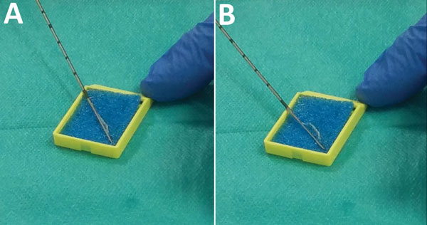 Application of biopsy needle on sponge used during transrectal ultrasound-guided prostate biopsy. A) Needle before scraping a biopsy core on sponge; B) needle after scraping to detach a biopsy core on sponge.