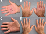 Thumbnail of Hands of  a 62-year-old man in Chicago, Illinois, USA, who had Mycobacterium arupense tenosynovitis, at the time treatment was sought (panels A, B) and after 6 months of treatment (panels C, D).