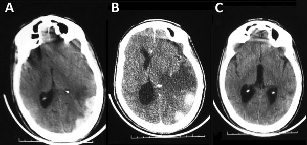 Computed tomography scan image of the brain of a 58-year-old man with Crimean-Congo hemorrhagic fever, Mauritania, 2012. A) Acute subdural hematoma, on the left side. B) Subdural hematoma with perihematomal edema and midline shift. C) Complete resorption of the subdural hematoma with residual edema, 1 month later.