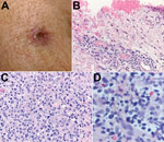 Thumbnail of A) Eschar on the right arm of patient 1 at the site of tick bite sustained in Santa Cruz County, Arizona, USA. B) Histological appearance of the eschar biopsy specimen showing ulcerated epidermis with hemorrhage and perivascular lymphohistiocytic inflammatory infiltrates in the superficial dermis. Hematoxylin-eosin staining; original magnification ×50. C) Dense lymphohistiocytic infiltrates around eccrine ducts in the deep dermis of the biopsy specimen. Hematoxylin-eosin staining; o