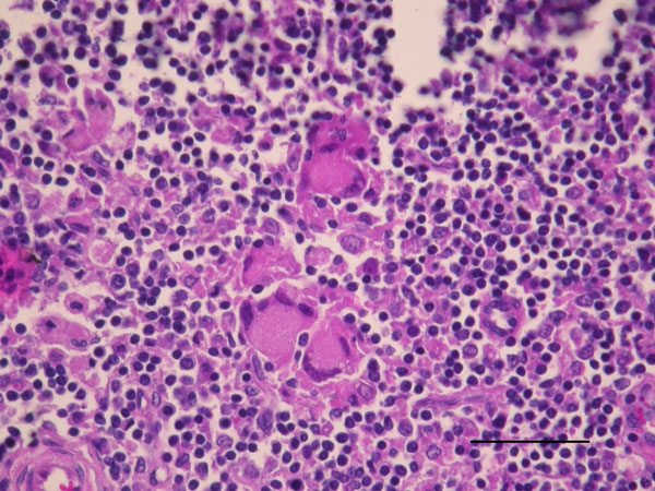 Goat lymph node granuloma with numerous Langhans-type multinucleated giant cells from a goat in France infected with Mycobacterium microti (hematoxylin and eosin stain). Scale bar indicates 50 μm.