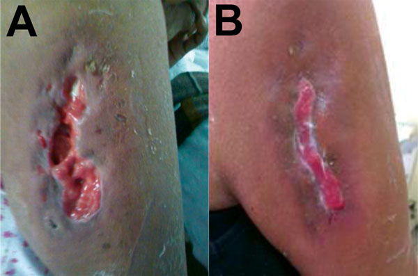 A) Untreated community-associated methicillin-resistant Staphylococcus aureus ulcer on the right arm of a 58-year old woman from a rural area of the Amazon Basin, Peru. B) The same ulcer after 19 days of treatment with vancomycin and trimethoprim/sulfamethoxazole. 