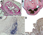 Thumbnail of Histologic and immunohistochemical analyses of resected pentastomid lesions from patients in Sankuru District, Democratic Republic of the Congo, 2014–2015. A) Typical necrotic pentastomid lesion from patient 5. Internal structures of the larvae are decayed; only the directly surrounding exuvia following the annulated body of the parasite and the fibrous capsule are visible. This organism has been moleculary identified as A. armillatus. Periodic acid Schiff stain; original magnificat