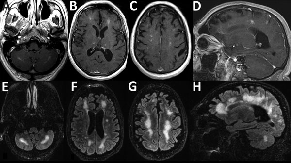 Magnetic resonance imaging scans showing brain abnormalities in a previously healthy adult with Baylisascaris meningoencephalitis, California, USA. A–D) Postgadolinium contrast T1 images obtained 4 weeks after symptom onset. A–C) Axial images, moving inferiorly to superiorly, demonstrating nodular bilateral enhancement within the cerebellar hemispheres, thalami, and subcortical white matter. D) Sagittal image further demonstrates multifocal areas of enhancement in cerebral hemispheres. Additiona