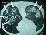 Thumbnail of Computed tomography radiograph of thorax showing chronic pulmonary histoplasmosis with bilateral cavitary infiltrates resembling pulmonary tuberculosis, coccidioidomycosis, paracoccidioidomycosis, and aspergillosis. Arrows indicate areas of abnormality. Image used with permission of Arnaldo Colombo (©2016, all rights reserved).