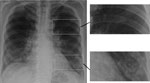 Thumbnail of Chest radiograph showing early, subtle Pneumocystis pneumonia–associated abnormalities in both lower lungs of a patient newly diagnosed with AIDS; this diagnosis was unsuspected in the patient, a 63-year-old married man. Magnified images on right show normal lung (top image) and infiltrates adjacent to and behind the heart and overlain by rib (bottom image). Similar differences between the upper and lower lobes are seen in the radiograph on the left. Image used with permission of Da