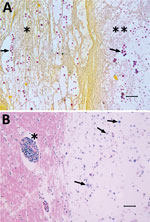 Thumbnail of Tissue from white-tailed deer (Odocoileus virginianus), showing microscopic lesions caused by a unique Cryptococcus gattii VGIIb variant strain most similar to that of the VGIIb genotype; etiology was confirmed by molecular sequencing. A) Photomicrograph of lung lesions with intralesional C. gattii (arrows indicate examples of individual yeast) in a mass (**) and in adjacent compressed alveolar spaces (*). Mucicarmine stain; original magnification ×10. B) Photomicrograph of a brains