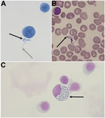 Thumbnail of A) Cytological slide prepared from cerebrospinal fluid (CSF) from a child with congenital trypanosomiasis who was born in France to an African mother (Gram staining, original magnification ×1,000). B) Blood smear from the child (May-Grunewald Giemsa [MGG] staining, original magnification ×1,000). C) Mott cell in the mother’s CSF (MGG staining, original magnification ×1,000). Trypomastigote forms of Trypanosoma brucei are extracellular structures, 2 × 25 μm, with a terminal flagellum