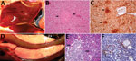 Thumbnail of Gross, histopathologic, and immunohistochemical (IHC) findings in common eider (Somateria mollissima) ducklings experimentally infected with Wellfleet Bay virus (2 days postinoculation). A) Liver, enlarged, showing multifocal pinpoint areas of necrosis (arrows). B) Hematoxylin and eosin stain of liver tissue, showing focal hepatocellular necrosis (arrows). C) IHC stain of liver tissue, showing positive immunolabeling for Wellfleet Bay virus with multifocal staining of hepatocytes (a