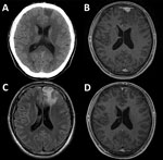 Thumbnail of Diagnostic imaging results for a brain mass in a 21-year-old HIV-positive man with cerebral syphilitic gumma in Tokyo, Japan, for whom serum samples obtained as recently as 5 months earlier showed negative results for syphilis. A) Noncontrast, cranial computed tomography showing a hypodense lesion in the left frontal lobe. B) Gadolinium-enhanced, axial, T1-weighted magnetic resonance imaging (MRI) showing an enhanced lesion (mass) (14 × 14 × 12 mm) adjacent to the enhanced dura in t