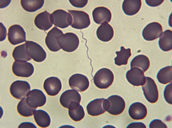 Spirochetes on a thick peripheral blood smear from a patient with tick-borne relapsing fever, southern Spain, 2004–2015.